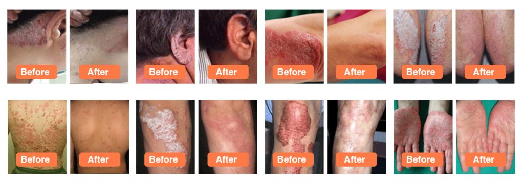 Psoriasis-Revolution-result
