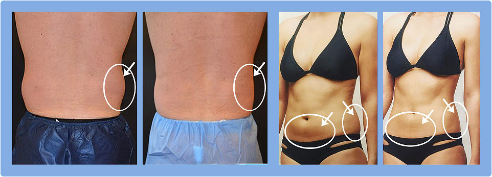 Fat Cell Killer System Before and After