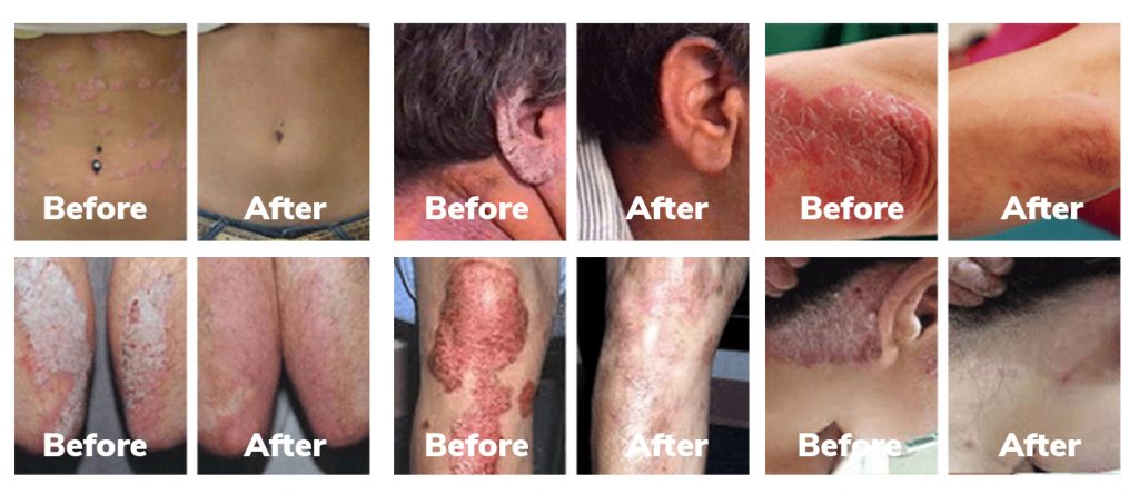 Psoriasis-Strategy-reviews