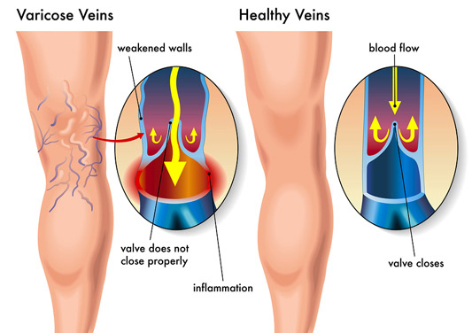 varicose veins
