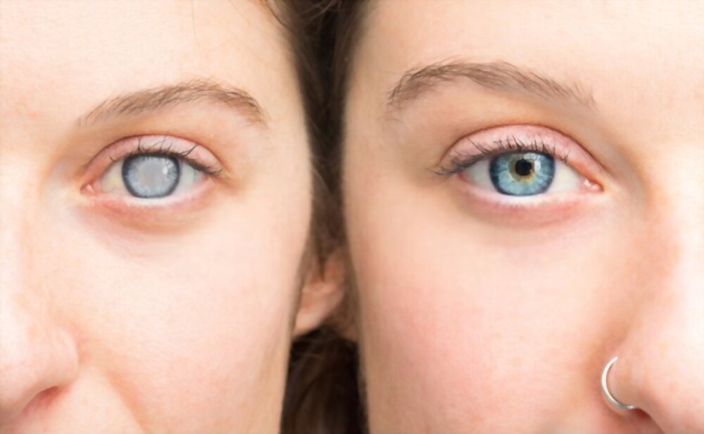 The First Signs Of Diabetic Retinopathy
