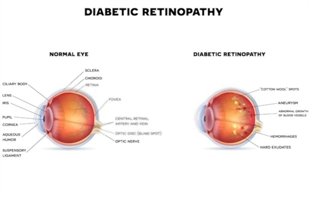 Treatments For Diabetic retinopathy