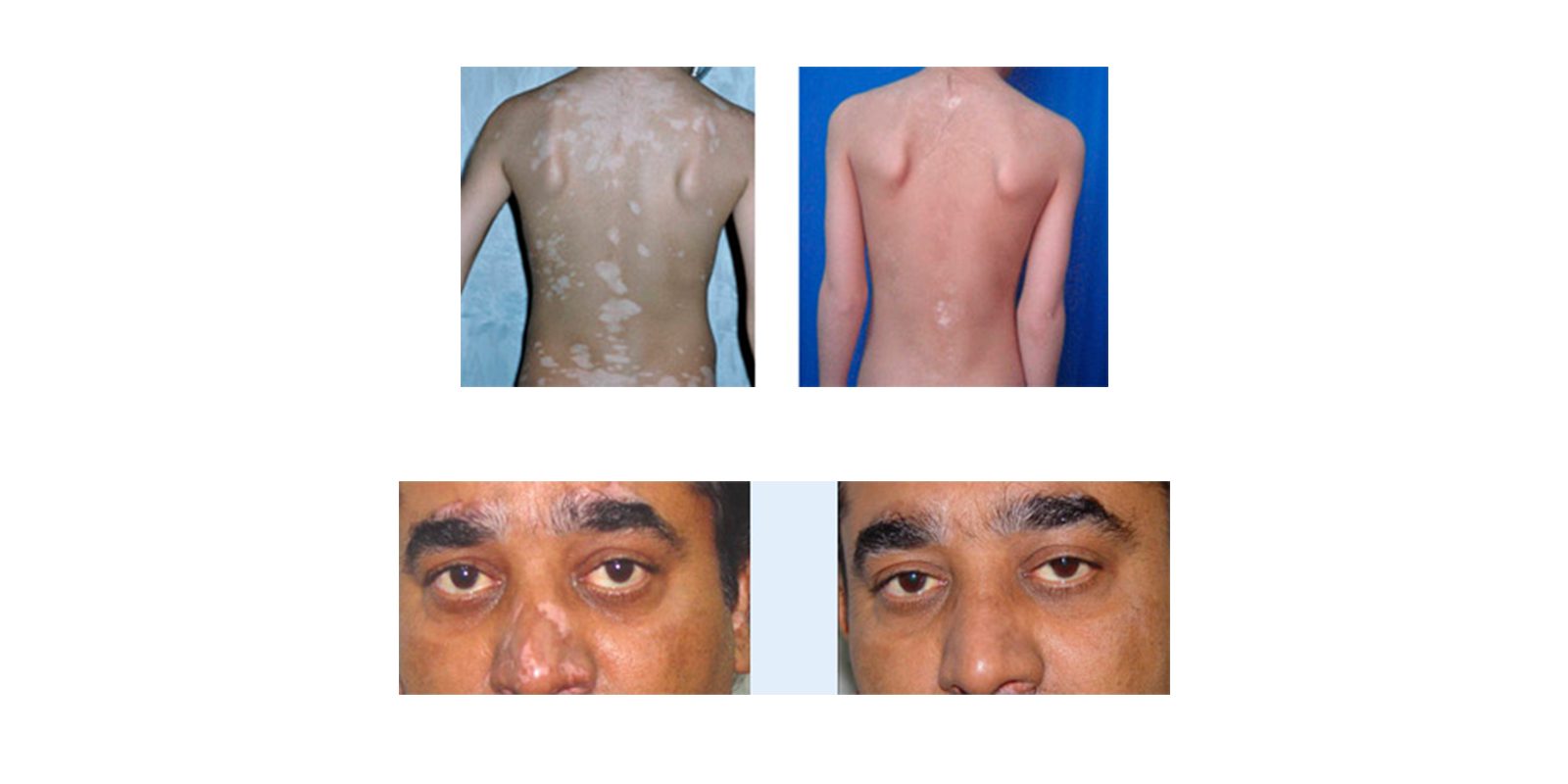 natural vitiligo treatment