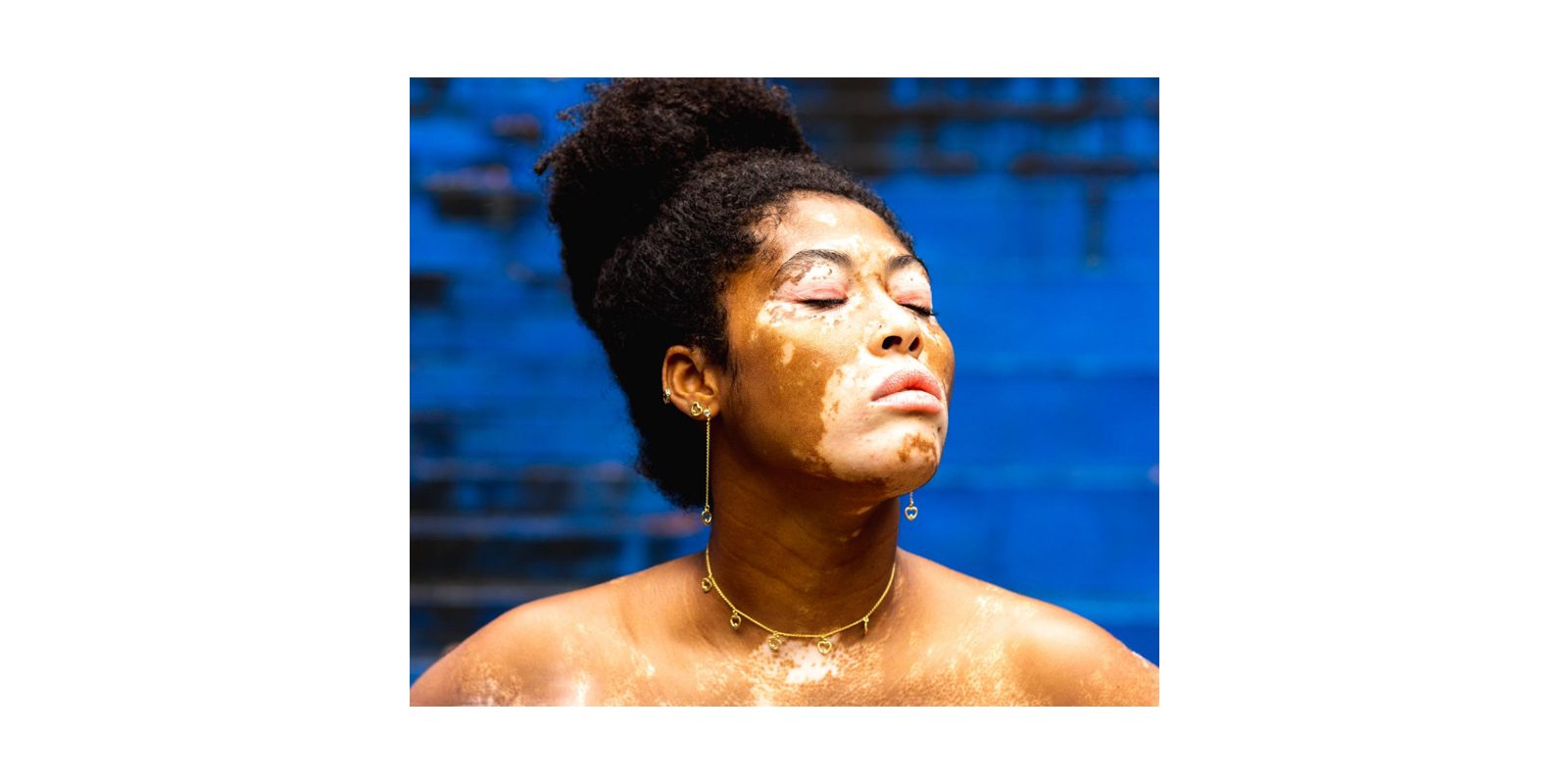 vitiligo treatment