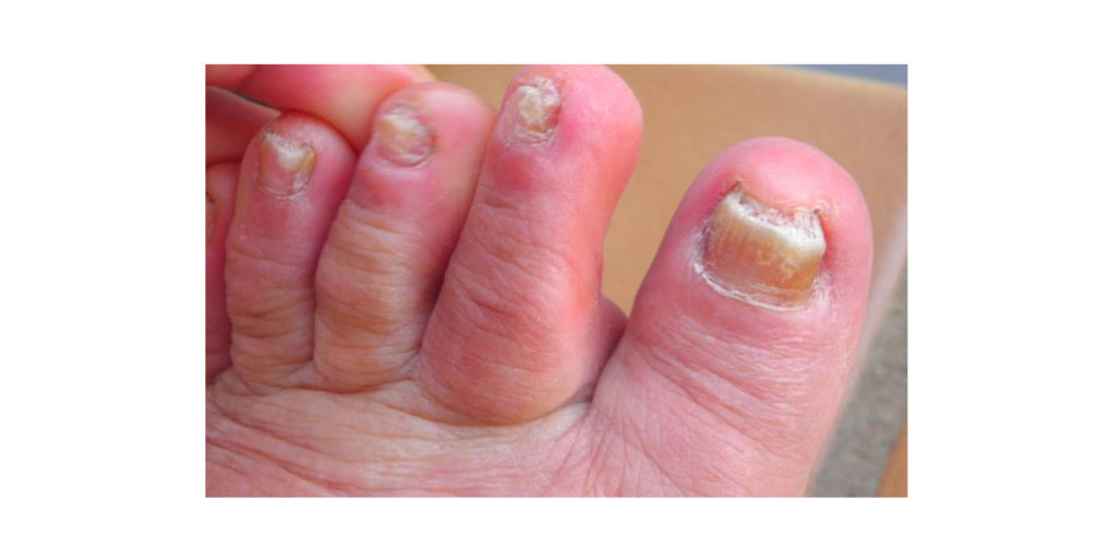 Toenail Fungus